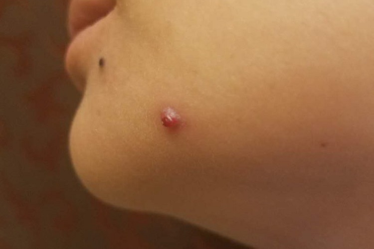 局限性口面部肉芽肿病下巴症状图