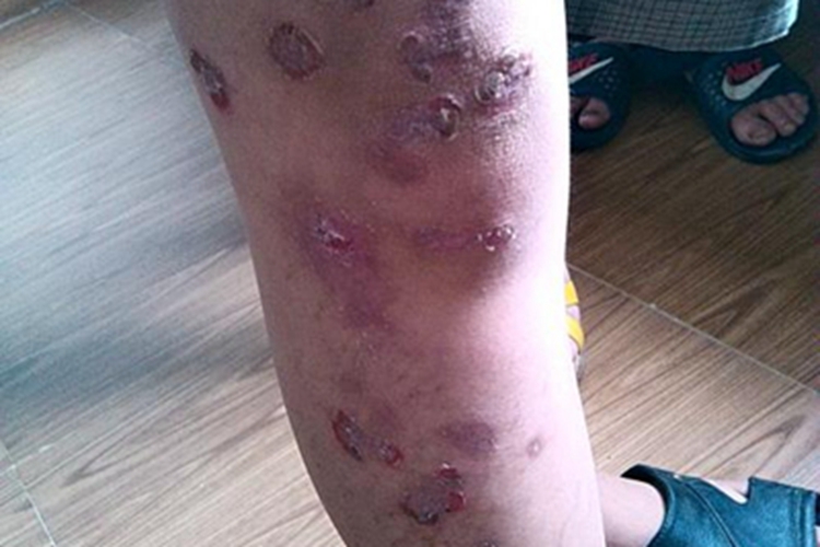 脓窝疮腿症状图