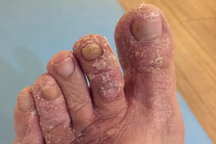 汗疱疹脚趾症状图