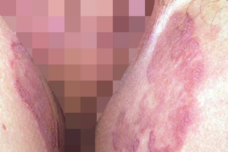 股癣大腿根部红斑脱屑图