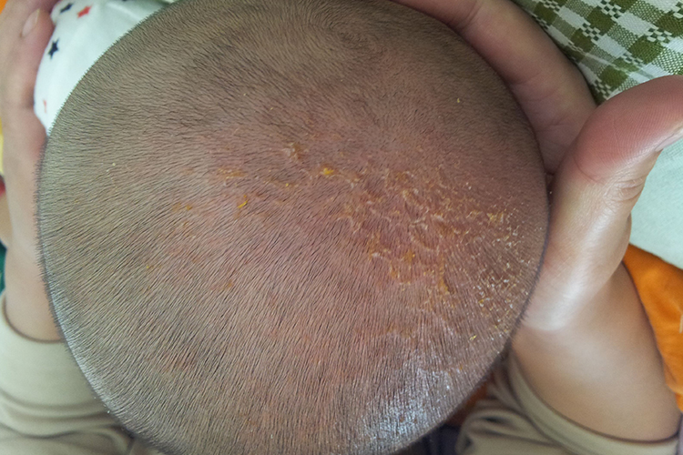 宝宝头上胎垢图