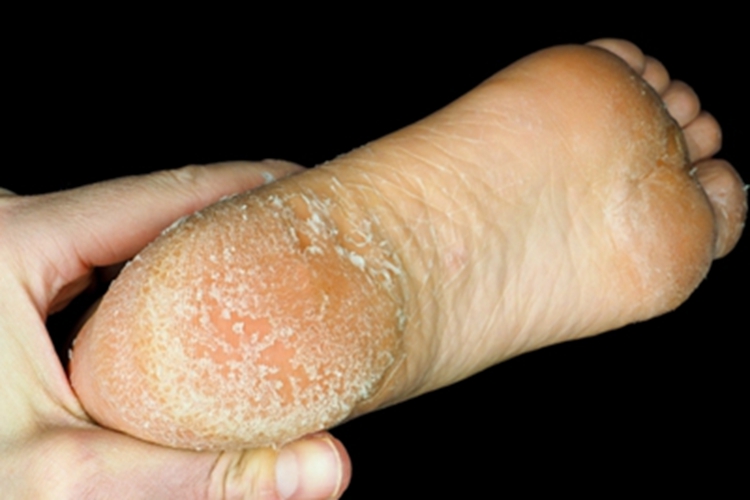 足部皲裂脚底干燥脱皮图 足部皲裂脚底干燥脱皮图