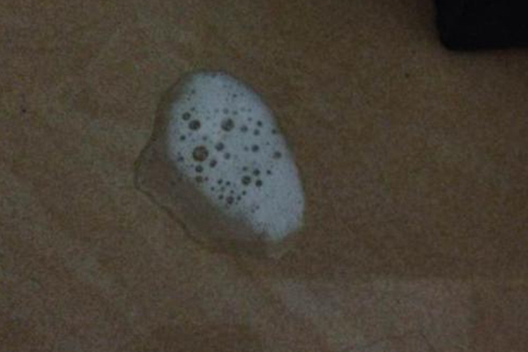 肺结核白色泡沫痰图