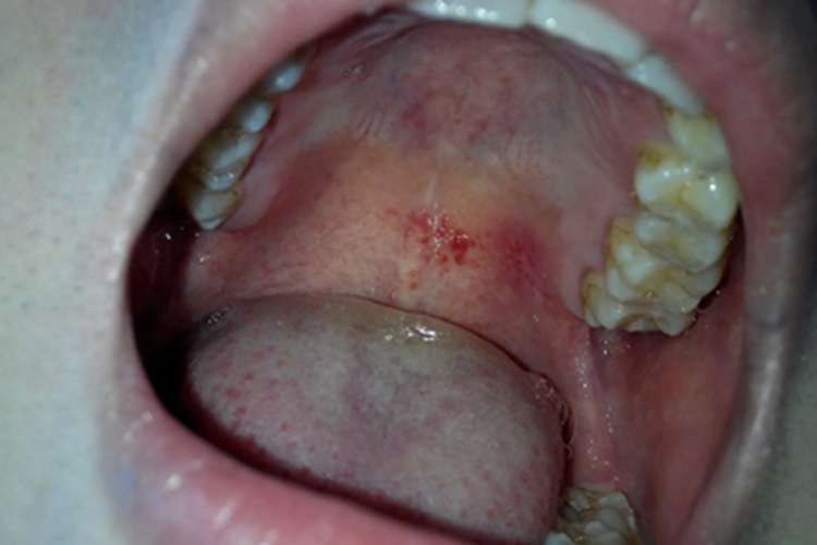 二期梅毒口腔症状图