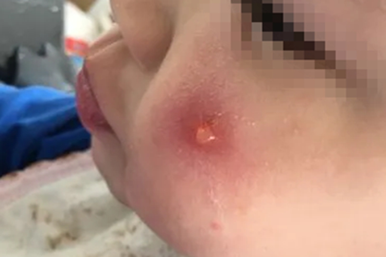 日晒伤脸上起水疱图