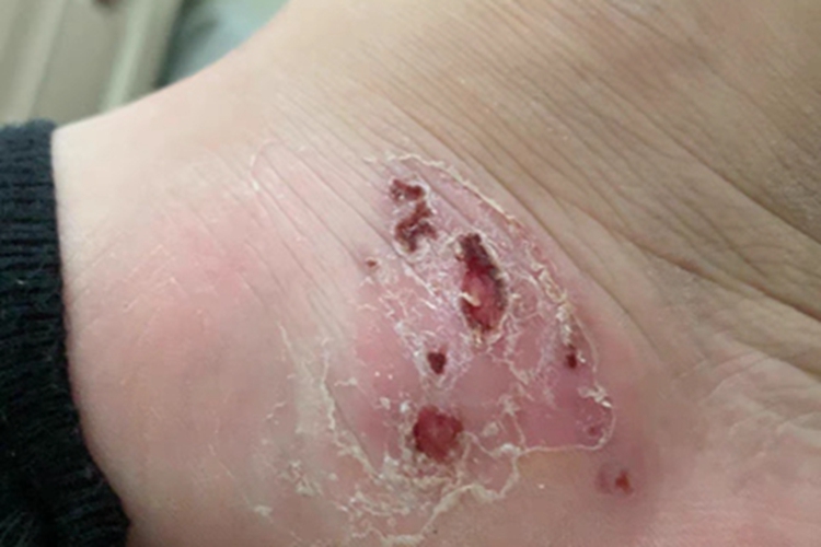 水疱型足癣脚踝结痂图 水疱型足癣脚踝结痂图