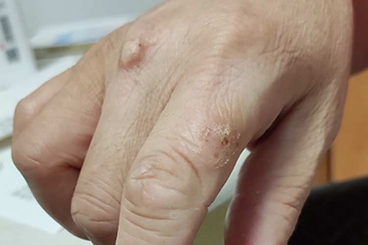 慢性湿疹手部结痂图 慢性湿疹手部结痂图