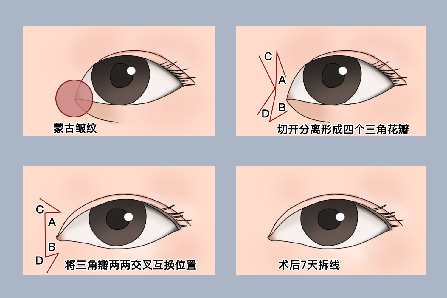 内眦开大术过程图 内眦开大术过程图