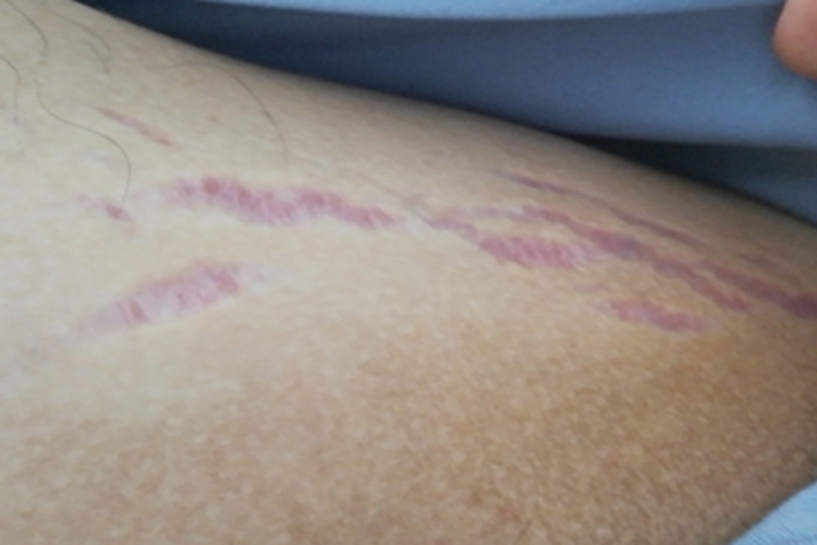 萎缩纹大腿有紫红色竖纹图 萎缩纹大腿有紫红色竖纹图