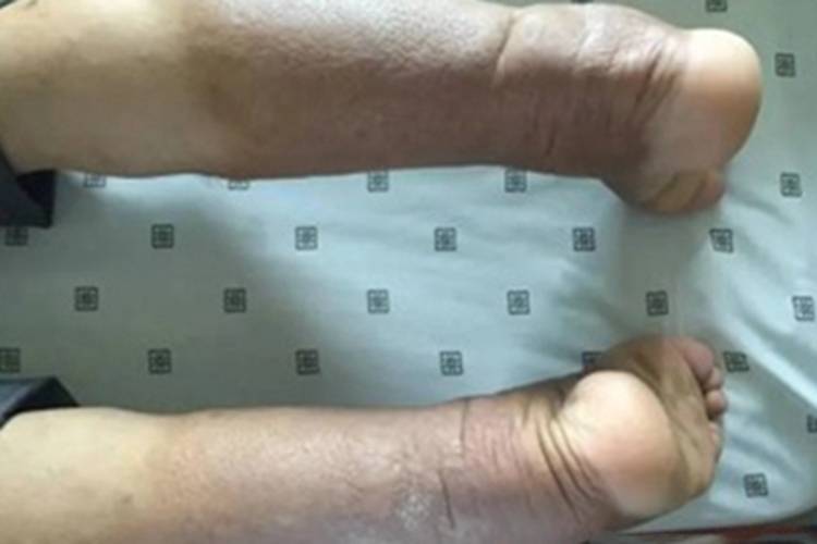 黏液水肿性苔藓小腿皮肤增厚图