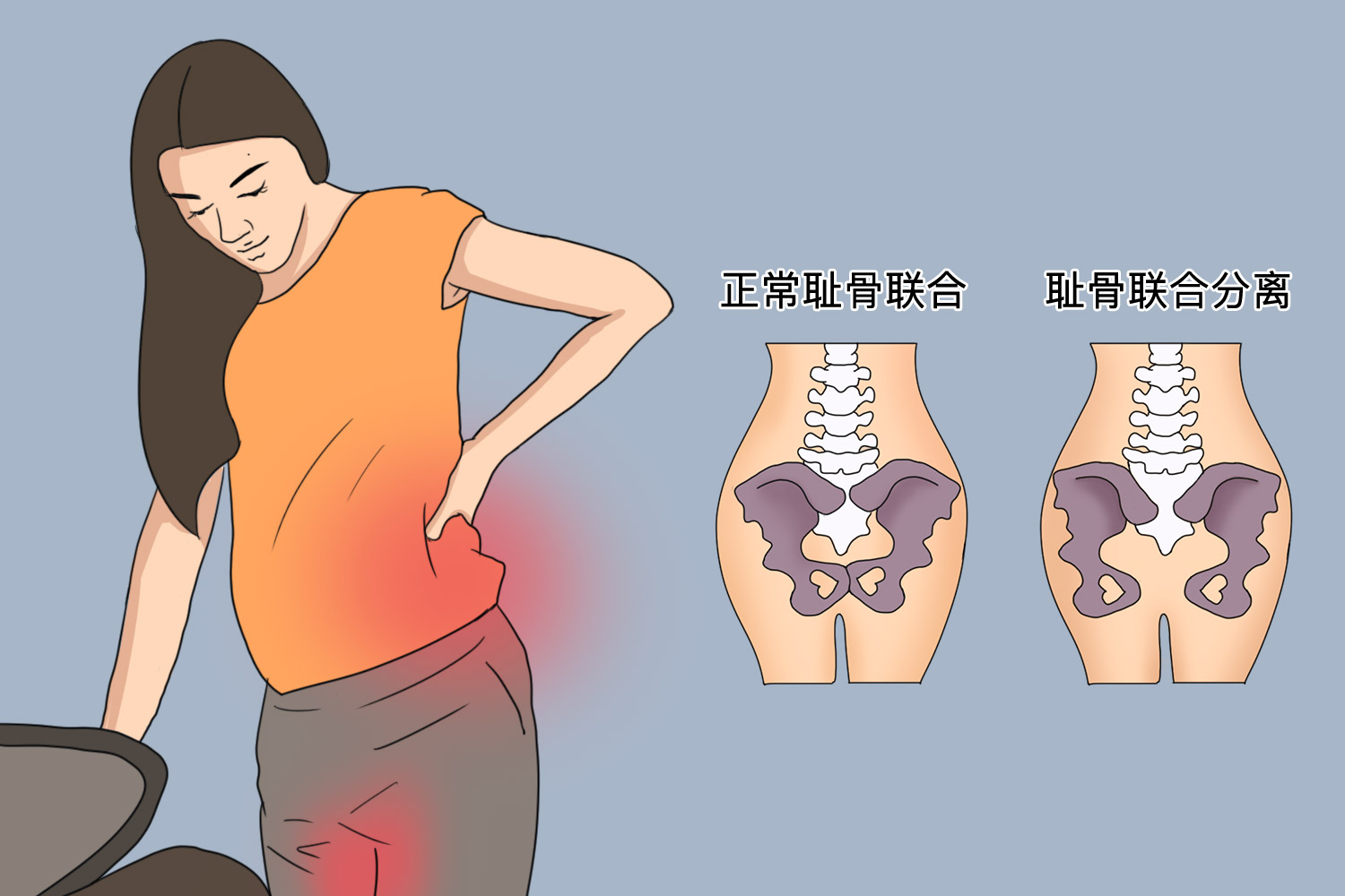 耻骨痛是哪里痛图片