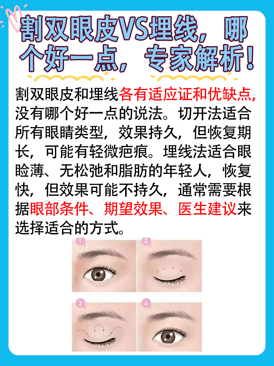 割双眼皮VS埋线，哪个好一点，专家解析！