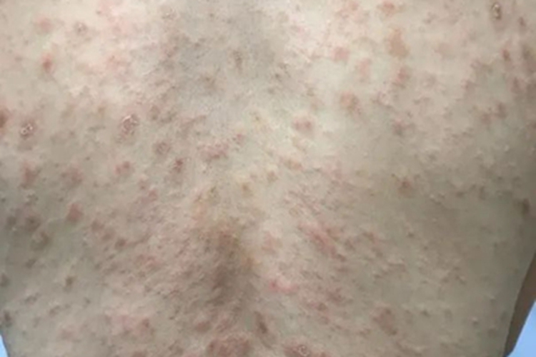 持久隆起性红斑背部症状图