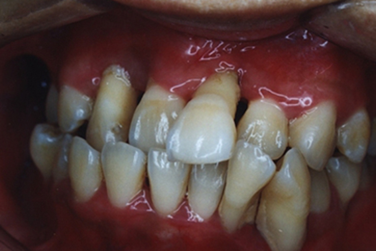 广泛型侵袭性牙周炎牙根暴露图 广泛型侵袭性牙周炎牙根暴露图