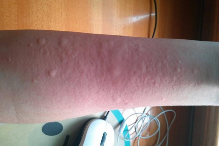 手臂过敏起红色风团图