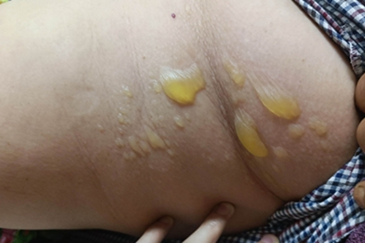 深脓疱疮大腿脓包图