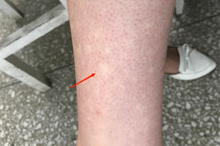 马歇尔-怀特综合征小腿白斑图