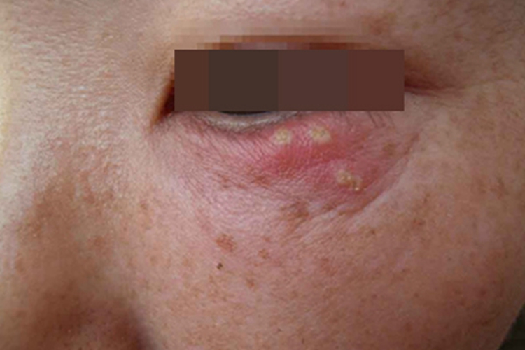 眼角单纯疱疹水疱伴红肿图