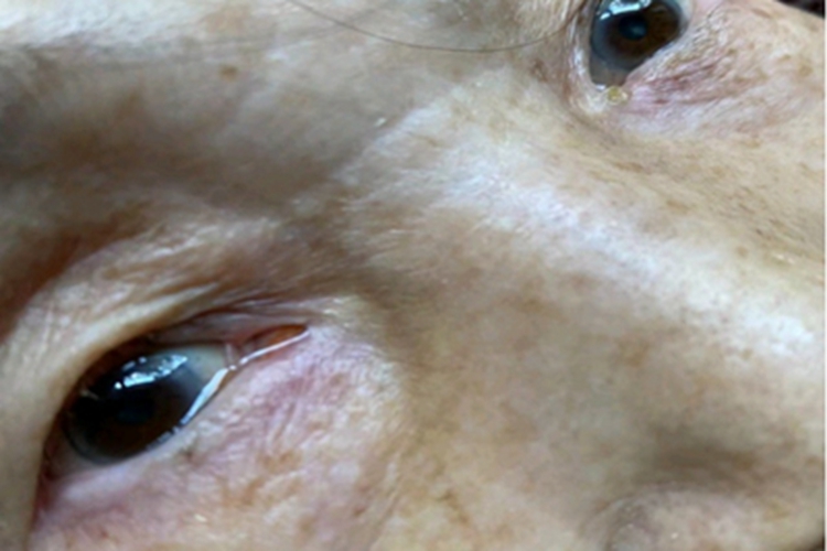 慢性泪囊炎眼部症状图