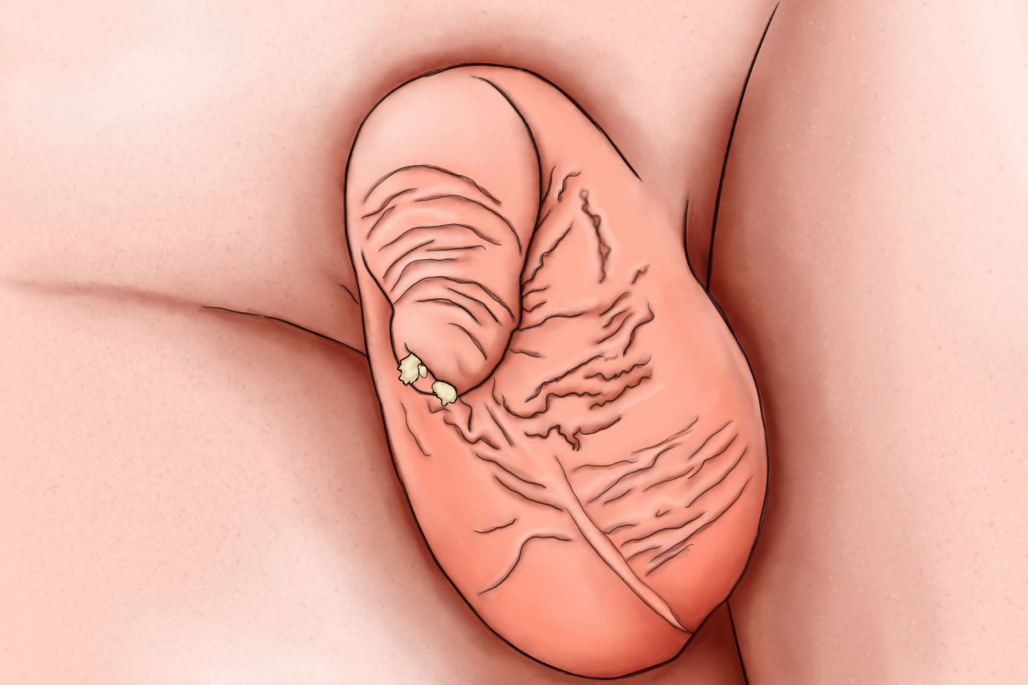 小孩子包茎过长图