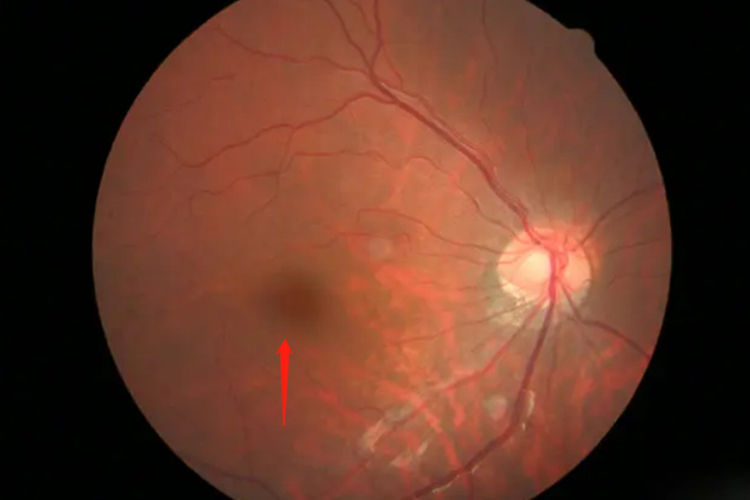 视网膜黑色素细胞瘤图