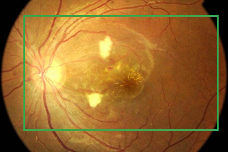 恶性高血压视网膜病变红血丝图 恶性高血压视网膜病变红血丝图