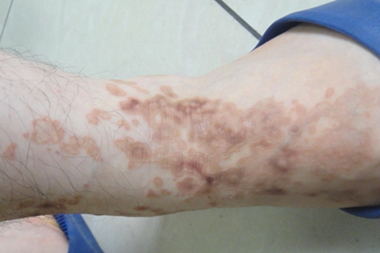 汗孔角化症长斑图