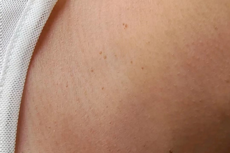 扁平疣脖子很多褐色小丘疹图