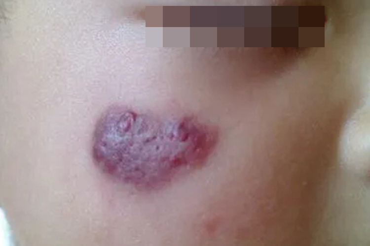 小孩血管瘤脸上疙瘩图