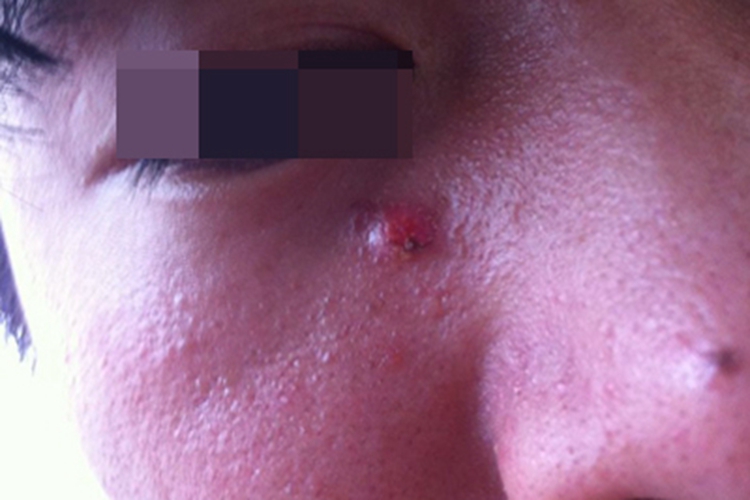 皮脂腺上皮瘤眼周结痂图