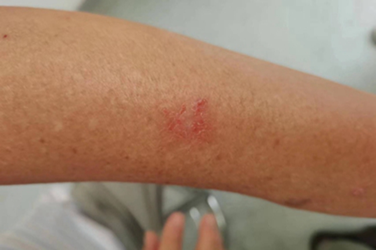 亚急性湿疹胳膊脱皮图