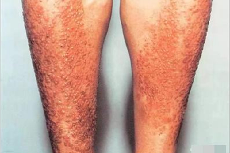 苔藓状淀粉样变小腿症状图