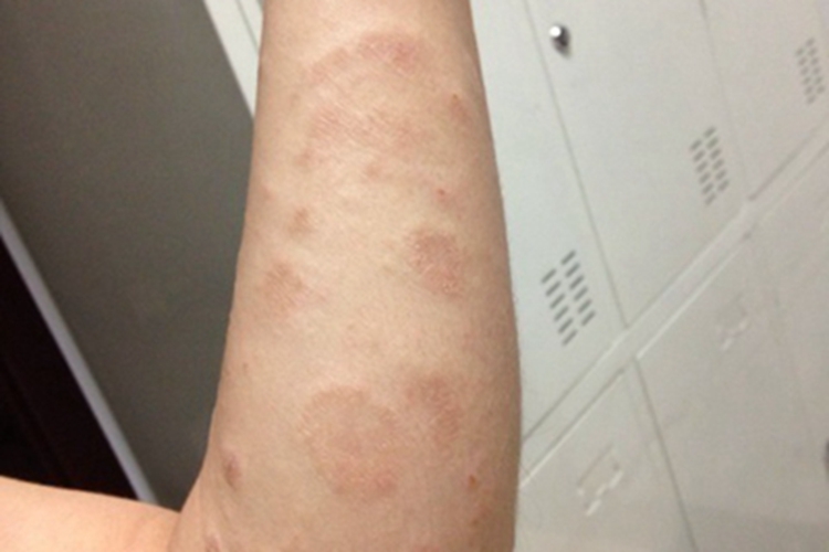 轻型多形红斑型药疹胳膊症状图 轻型多形红斑型药疹胳膊症状图