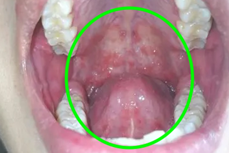 二期口腔梅毒红点图 二期口腔梅毒红点图