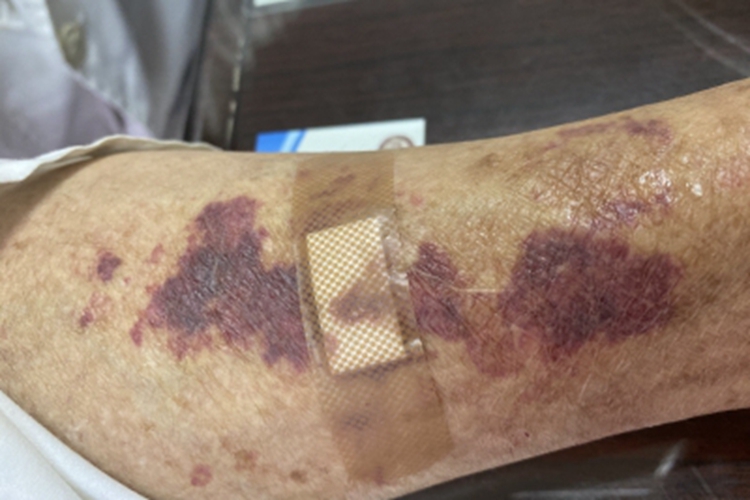 老年性紫癜胳膊症状图