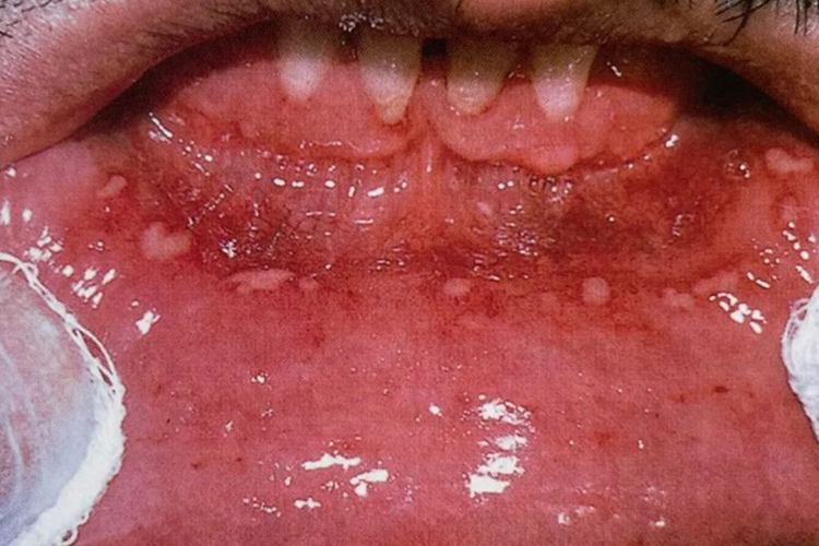 疱疹样口腔溃疡图 疱疹样口腔溃疡图