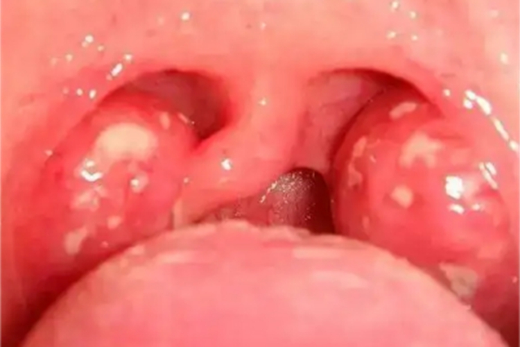 淋菌性咽炎化脓图