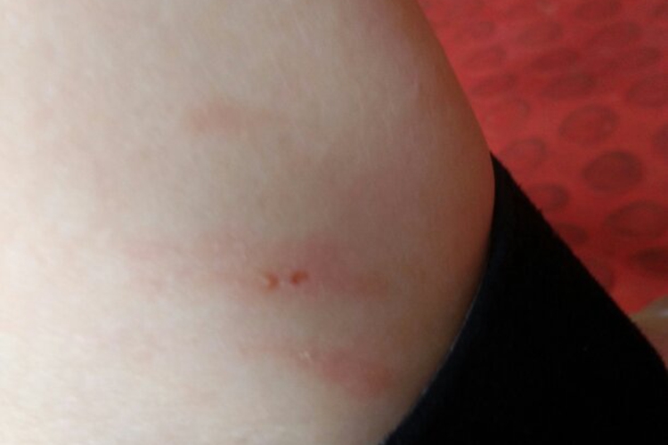 狂犬病Ⅱ级暴露图 狂犬病Ⅱ级暴露图