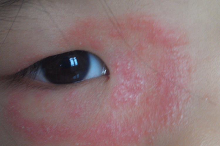 植物性皮炎眼周丘疹图 植物性皮炎眼周丘疹图