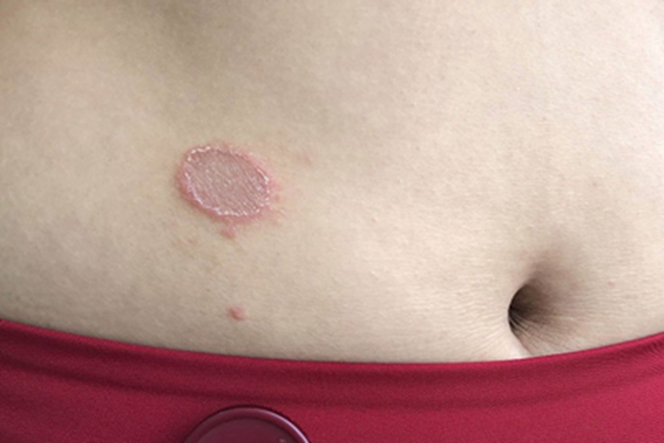 体癣右腹部小块红斑有鳞屑图