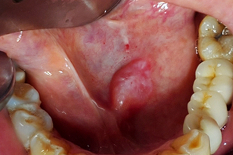 涎腺囊肿疙瘩图