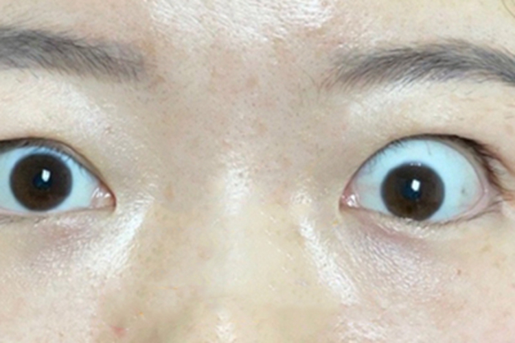 甲状腺相关眼病眼球症状图