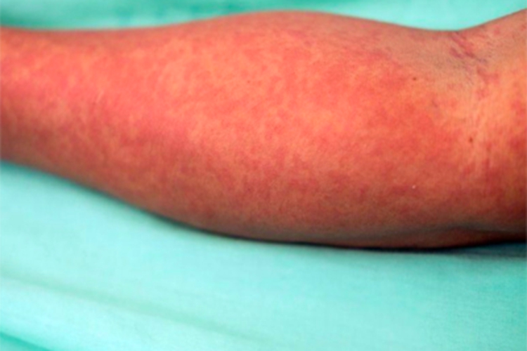 典型麻疹出疹期胳膊症状图 典型麻疹出疹期胳膊症状图