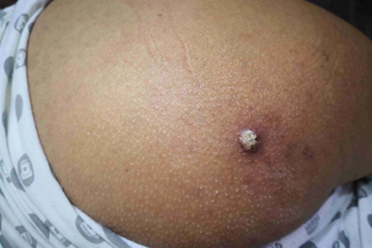 皮肤钙质沉着症臀部症状图