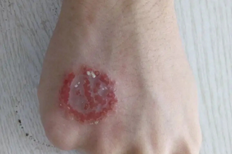 钱币状湿疹手背脱屑图