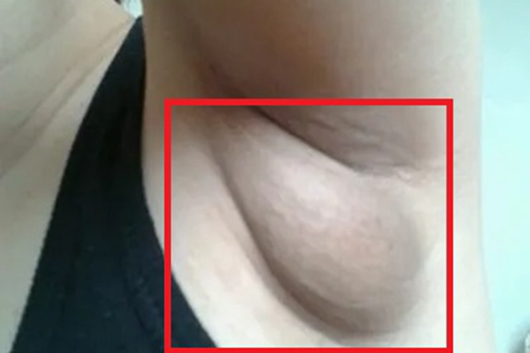 脂肪瘤腋窝有一个大疙瘩图