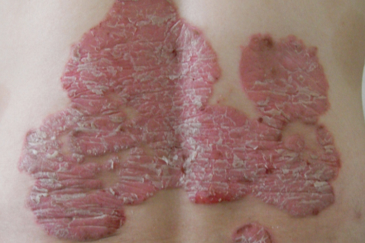 蛎壳状银屑病图