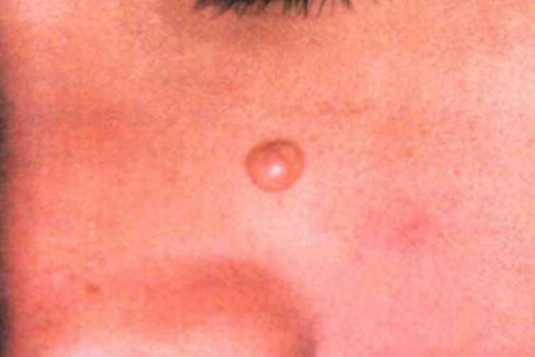 毛母质瘤表面皮肤图