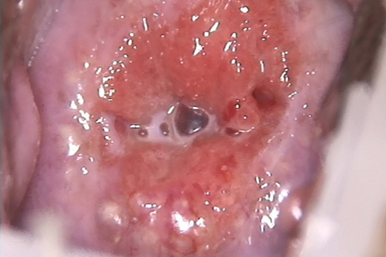 阴道炎早期症状图