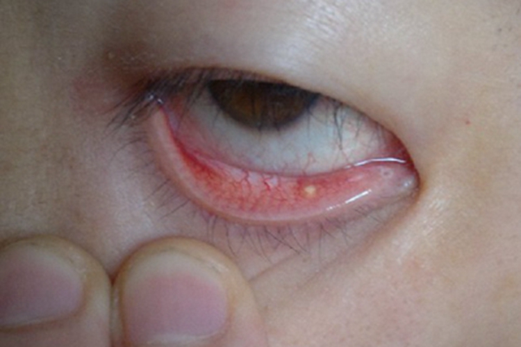 滤泡性结膜炎结膜小疙瘩图